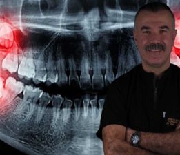 Yirmilik Dişler İhmale Gelmiyor Gülüşünüz Bozulabilir